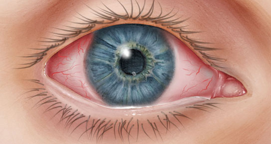 Primer plano de un ojo con conjuntivitis.