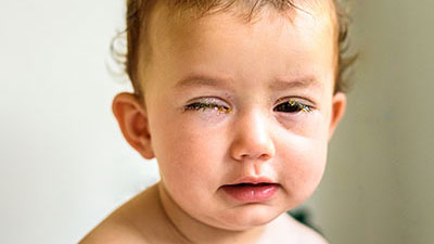 Bebé que muestra síntomas de conjuntivitis, como costras en los párpados.